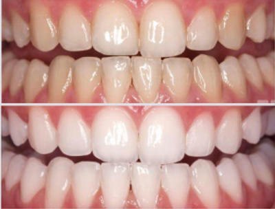 Denti prima e dopo lo sbiancamento